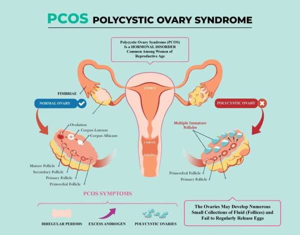 PCOS: All you need is the right guidance - Wellfinity
